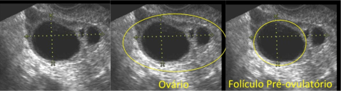 usg-ovario-ovulac%cc%a7a%cc%83o-legendado